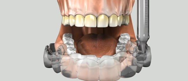 Single Visit Whitening